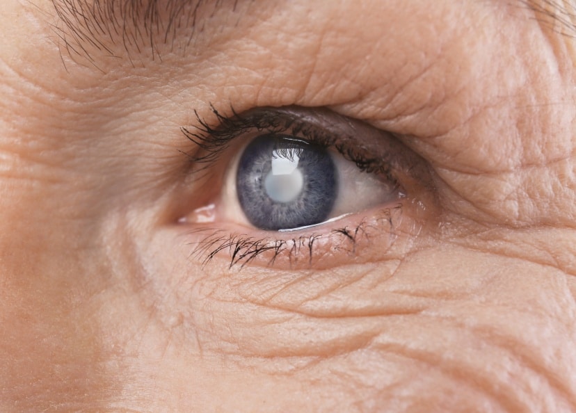 Cataracte : traitements à Strasbourg | Trouble de la vue et maladie de l'oeil | Dr Cédric Grasswill