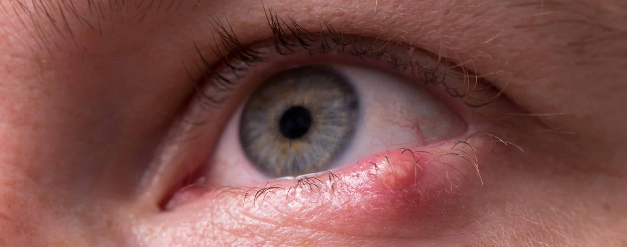 Orgelet et chalazion | Dr Grasswill | Strasbourg