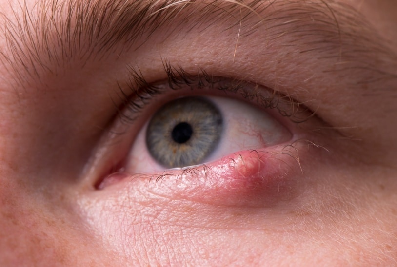Orgelet et chalazion | Dr Grasswill | Strasbourg