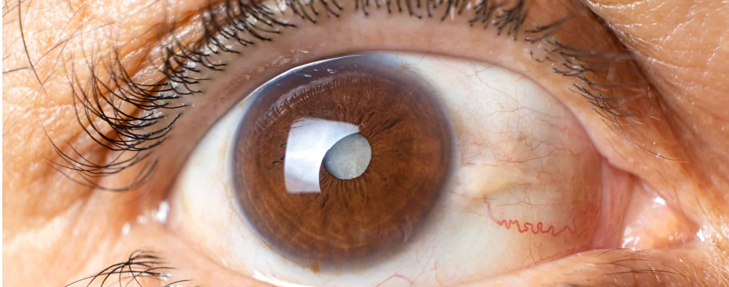 Interventions pratiquées par un chirurgien ophtalmologiste | Dr Grasswill | Strasbourg