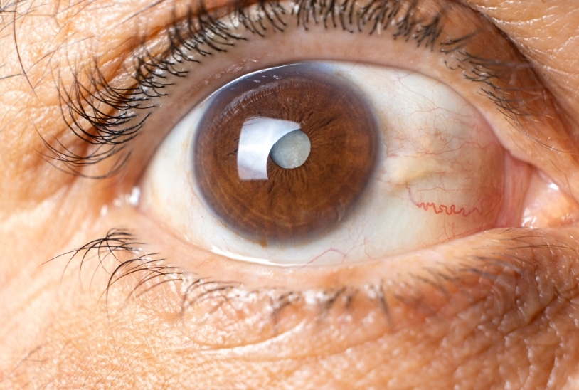 Interventions pratiquées par un chirurgien ophtalmologiste | Dr Grasswill | Strasbourg